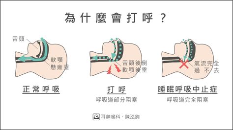 陳泓鈞醫師｜新竹竹北耳鼻喉專科推薦 您不能小看打呼的三大陷阱，懶人包一次掌握！