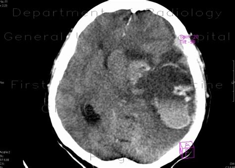 Radiology Case Intraparenchymal Hemorrhage