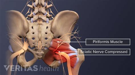 Piriformis Syndrome Pain