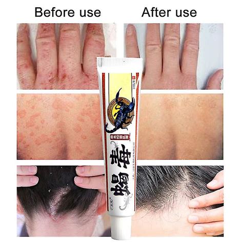 Psoriasis Cream Eczema Ointment Scalp Psoriasis Hand Tinea Foot Odor