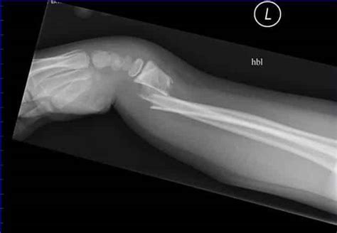 Smith Fracture X Ray