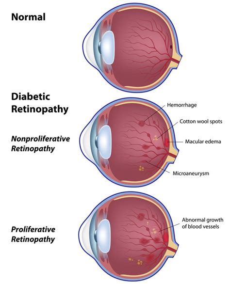 Diabetic Retinopathy - Stereo Optical