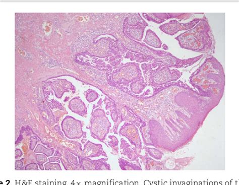 Figure From Syringocystadenoma Papilliferum In A Year Old Adult A