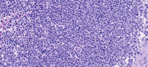 Embryonal rhabdomyosarcoma showing a diffuse proliferation of tumour... | Download Scientific ...