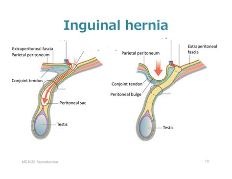 Diagram Of W3 Inguinal Hernia Quizlet