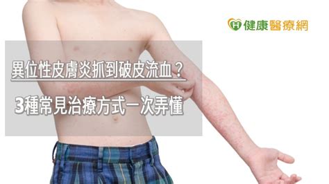 異位性皮膚炎抓到破皮流血？ 3種常見治療方式一次弄懂 健康醫療網