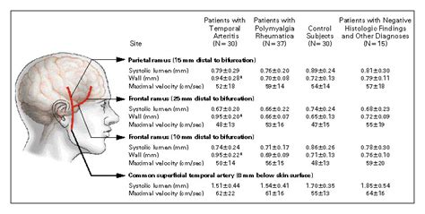 Color Duplex Ultrasonography In The Diagnosis Of Temporal Arteritis New England Journal Of