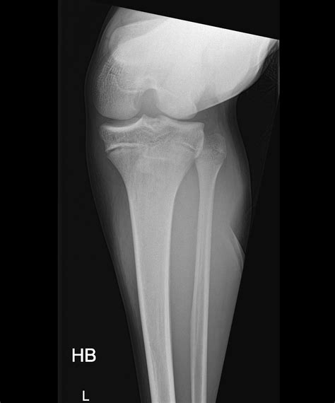 Tibial Tuberosity Avulsion Fracture Image