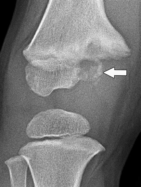 Imaging Of Pediatric Growth Plate Disturbances Radiographics