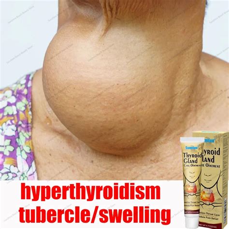 Thyroid Thyroid Cream Thyroid Nodule Ointment G Thyroiditis Pain