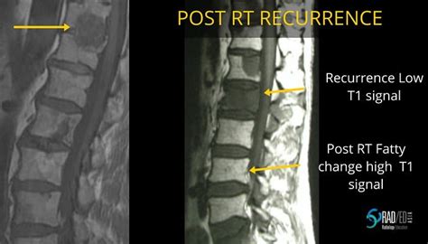 Mri Radiation Spine When The Clinicians Wont Tell You Radedasia