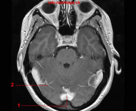 Intracranial Venous System W Radiology