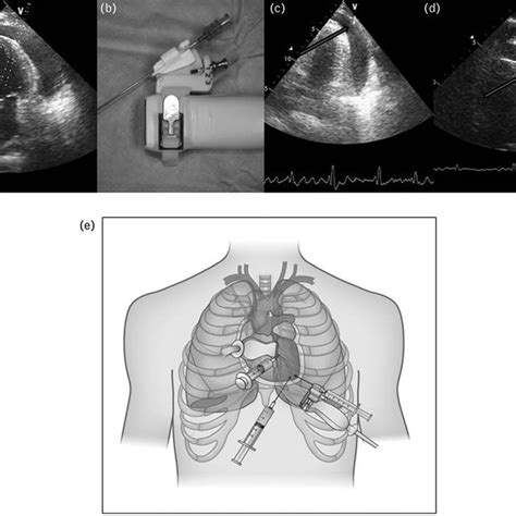 Pdf Evolution Of The Pericardiocentesis Technique