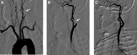 Simulation Of Carotid Artery Stenting Reduces Training Procedure And Fluoroscopy Times Journal