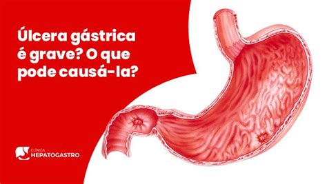 Úlcera Gástrica é Grave O Que Pode Causá la Clínica Hepatogastro