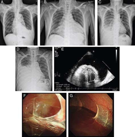 Chest Radiographs Of The Four Patients Upon Initial Presentation Download Scientific Diagram