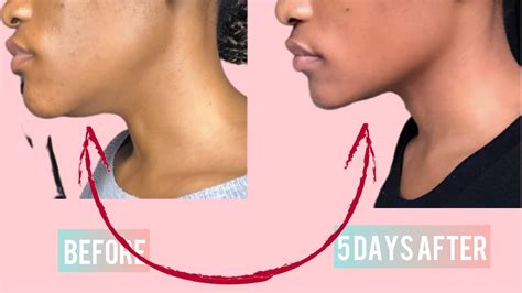 Double Chin Fat And Face Lift 5 Days Workout Challenge Inspired By