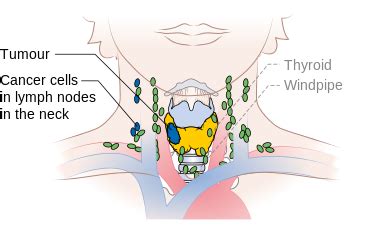 Papillary thyroid cancer staging - wikidoc