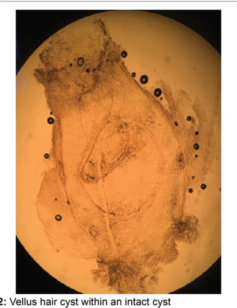 Top 111 Eruptive Vellus Hair Cysts Cause Polarrunningexpeditions