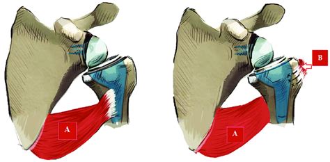 Figure Scheme Of Latissimus Dorsi Transfer M Latissimus Dorsi B