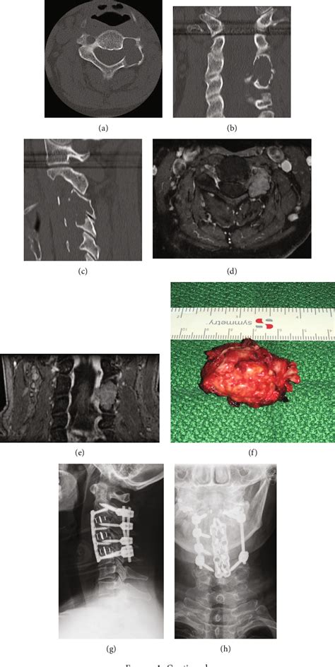 Figure 1 From Patient Matched 3 D Printed Guides For The Insertion Of