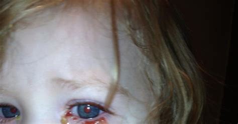 Zadie's Journey: Zadie's bloody eye