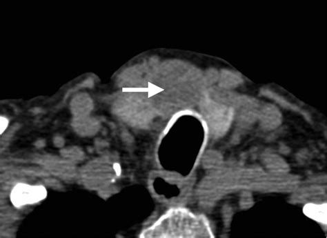 Papillary Thyroid Cancer Axial Ct Scan Demonstrates A Hypoattenuated