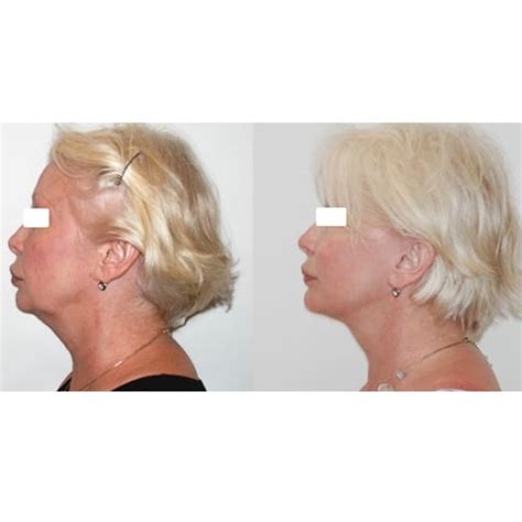 Photos Avant Apr S Un Lifting Cervico Facial