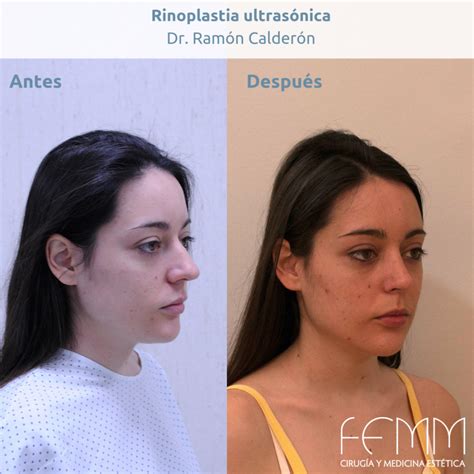 Rinoplastia Ultrasónica La Forma Más Precisa De Esculpir La Nariz