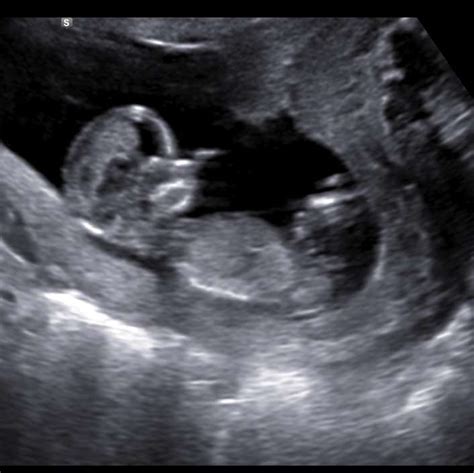 12 Week 3D Ultrasound: What to Expect?