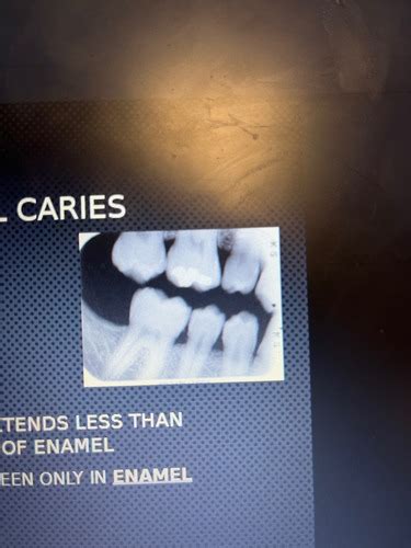 33 Interpretation Of Dental Caries Flashcards Quizlet