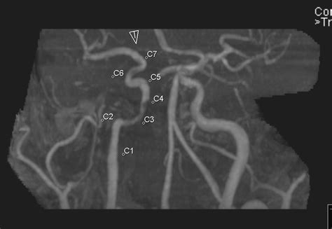 Radiology Mri Carotis Segments