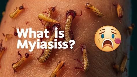 Myiasis Explained Symptoms Causes And Prevention Of Maggot