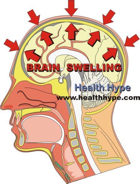 Pressure On The Brain Process Causes And Symptoms