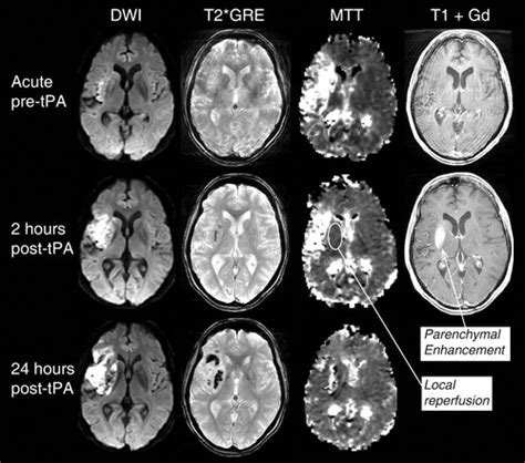 MRI Detection of Early Blood-Brain Barrier Disruption | Stroke