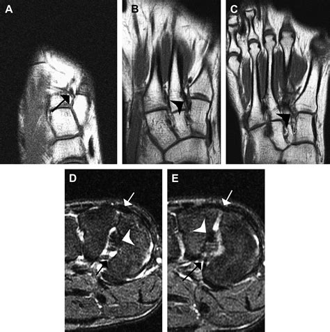 Mr Imaging Evaluation Of Subtle Lisfranc Injuries The Midfoot Sprain