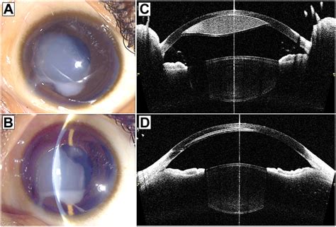 A Fluid Filled Pocket Of Descemet Membrane Detachment Ophthalmology