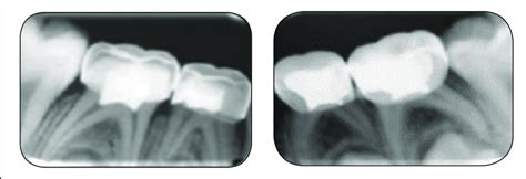 Twelve Month Postoperative Periapical Radiographs Of The Same Teeth