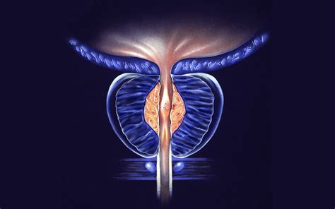 Enlarged Prostate Bph Urology Clinics Of North Texas