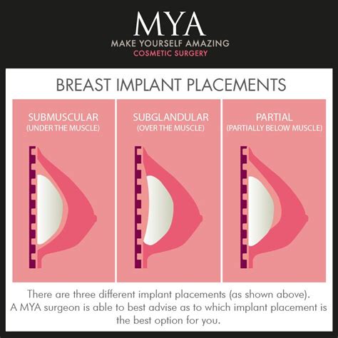 Pin On Mya Before And After Images