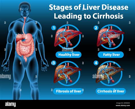 Etapas De La Enfermedad Hep Tica Que Conducen A La Ilustraci N De La