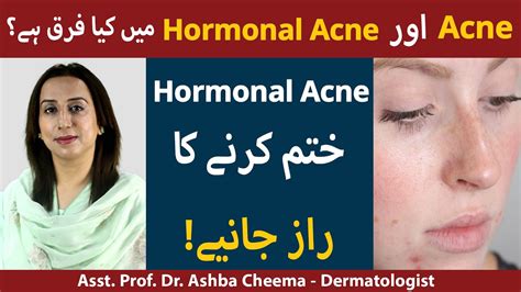 How To Treat Hormonal Acne Acne Khatam Karne Ka Tarika Hormonal