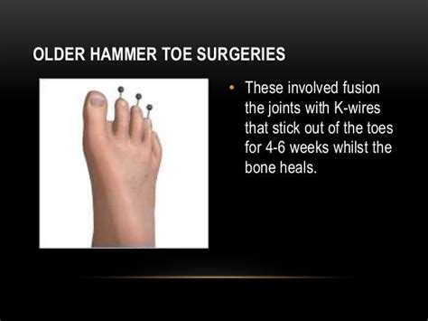 Hammer Toe Surgery Modern Day Toe Operation