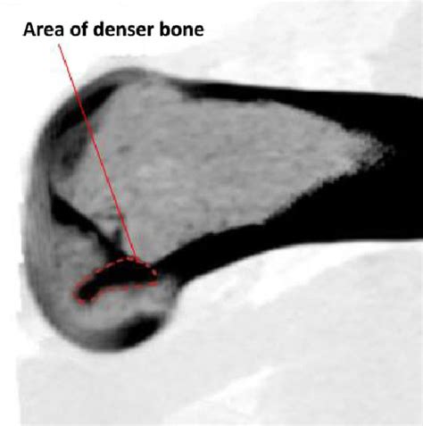 Figure From Relationship Between Number Of Lateral Intercondylar