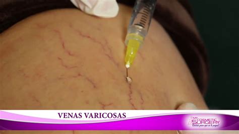 TRATAMIENTO DE VENAS VARICOSAS EN MY COSMETIC SURGERY MIAMI YouTube