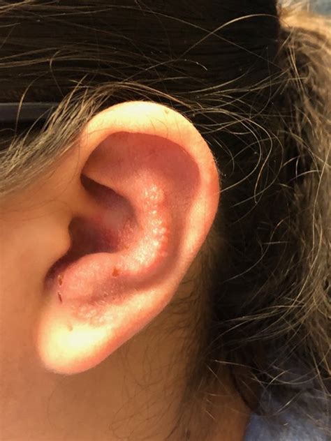 Ramsay Hunt Syndrome Ear