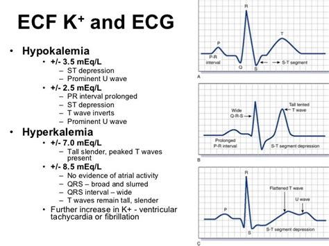 Hyperkalemia Ecg Findings Silopeprograms