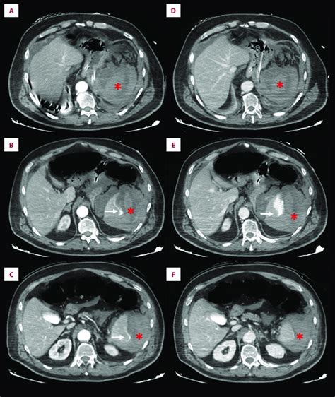 A F Computed Tomography Demonstrated Rupture Of The Spleen With A