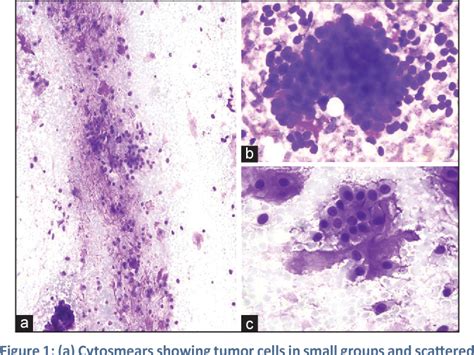 Figure 1 From Fine Needle Aspiration Cytology Of Myoepithelial