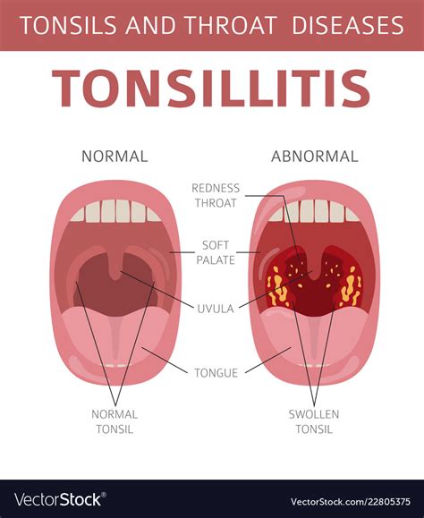 Tonsils and throat diseases tonsillitis symptoms Vector Image